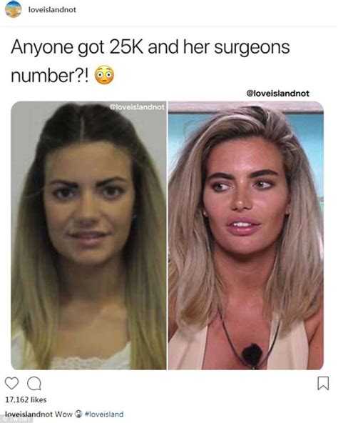 mackenzie love island before surgery.